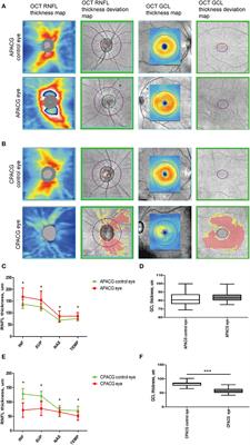 Alteration of neurofilament heavy chain and its phosphoforms reveals early subcellular damage beyond the optic nerve head in glaucoma
